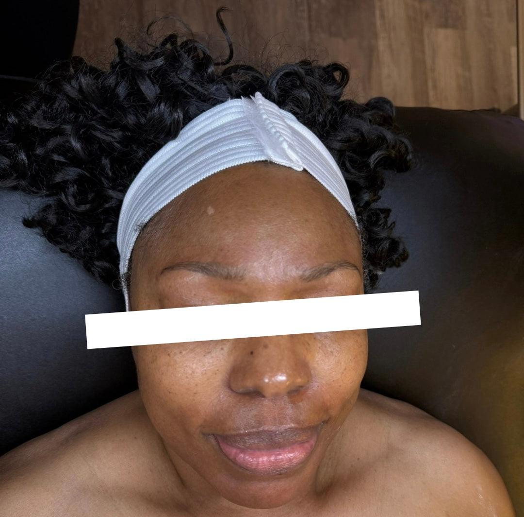 Before Combo Treatment - Series of Aerolase Neo + The Glow Facial