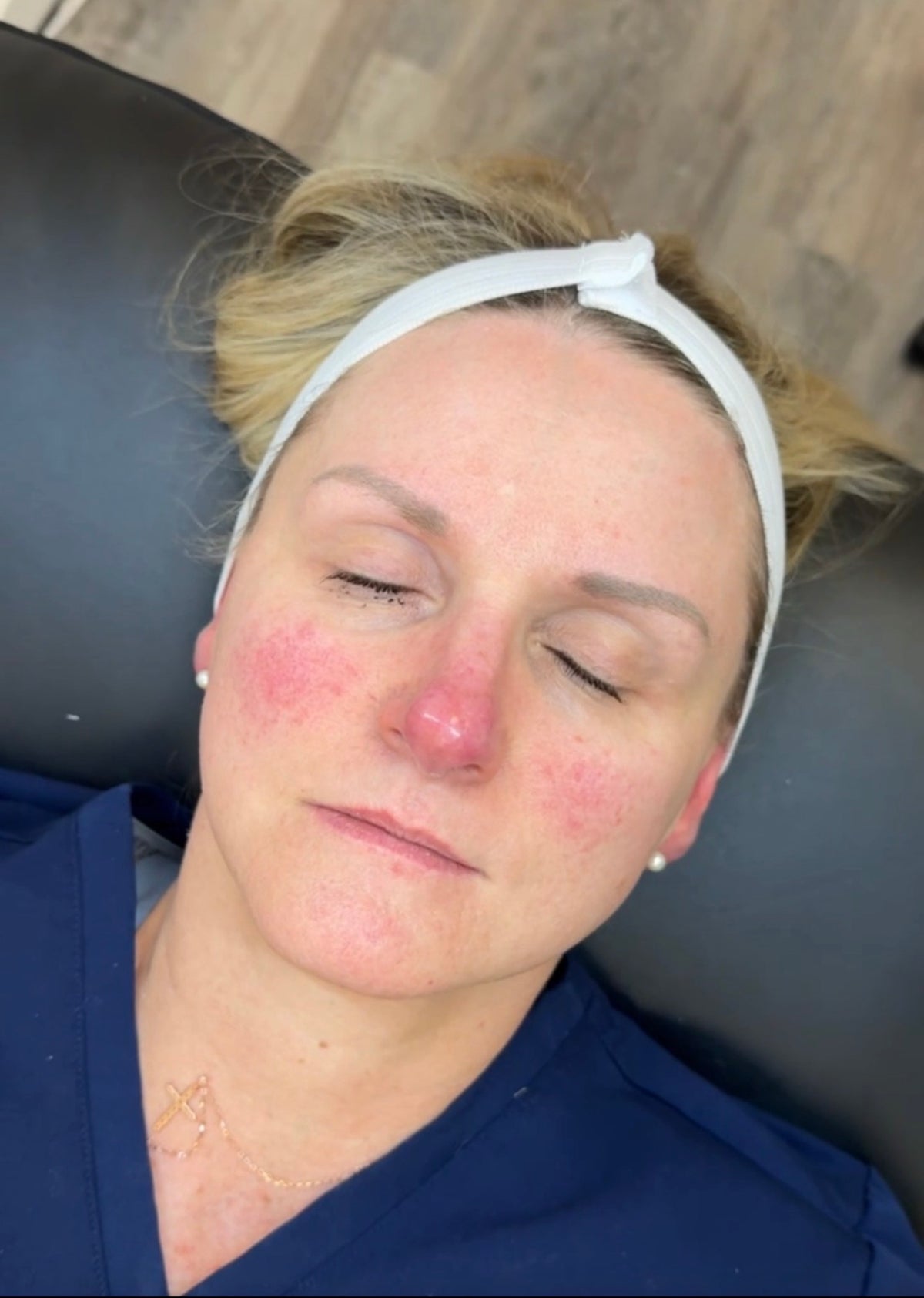 Before Aerolase Neo - 2 Treatments