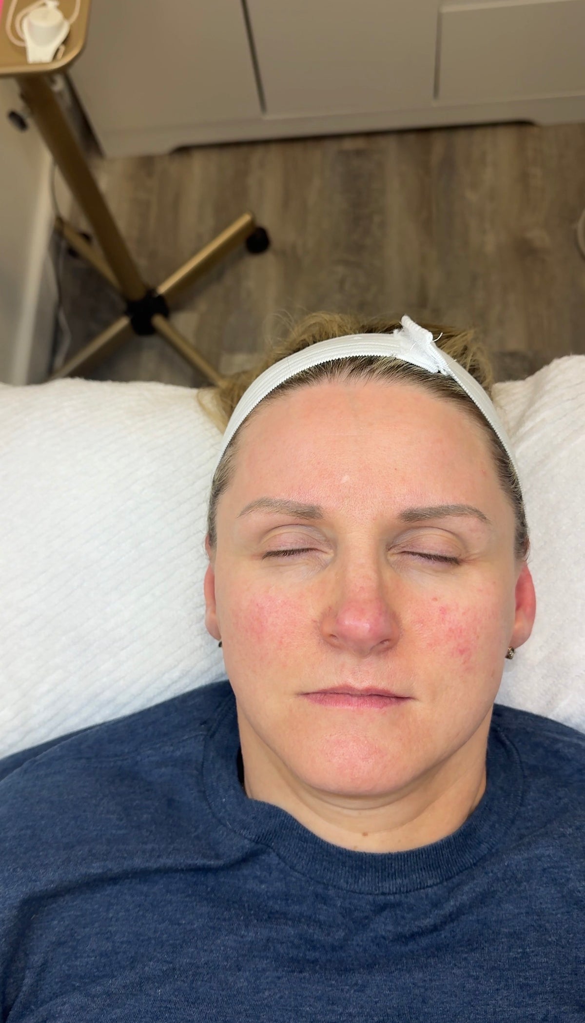 After Aerolase Neo - 2 Treatments