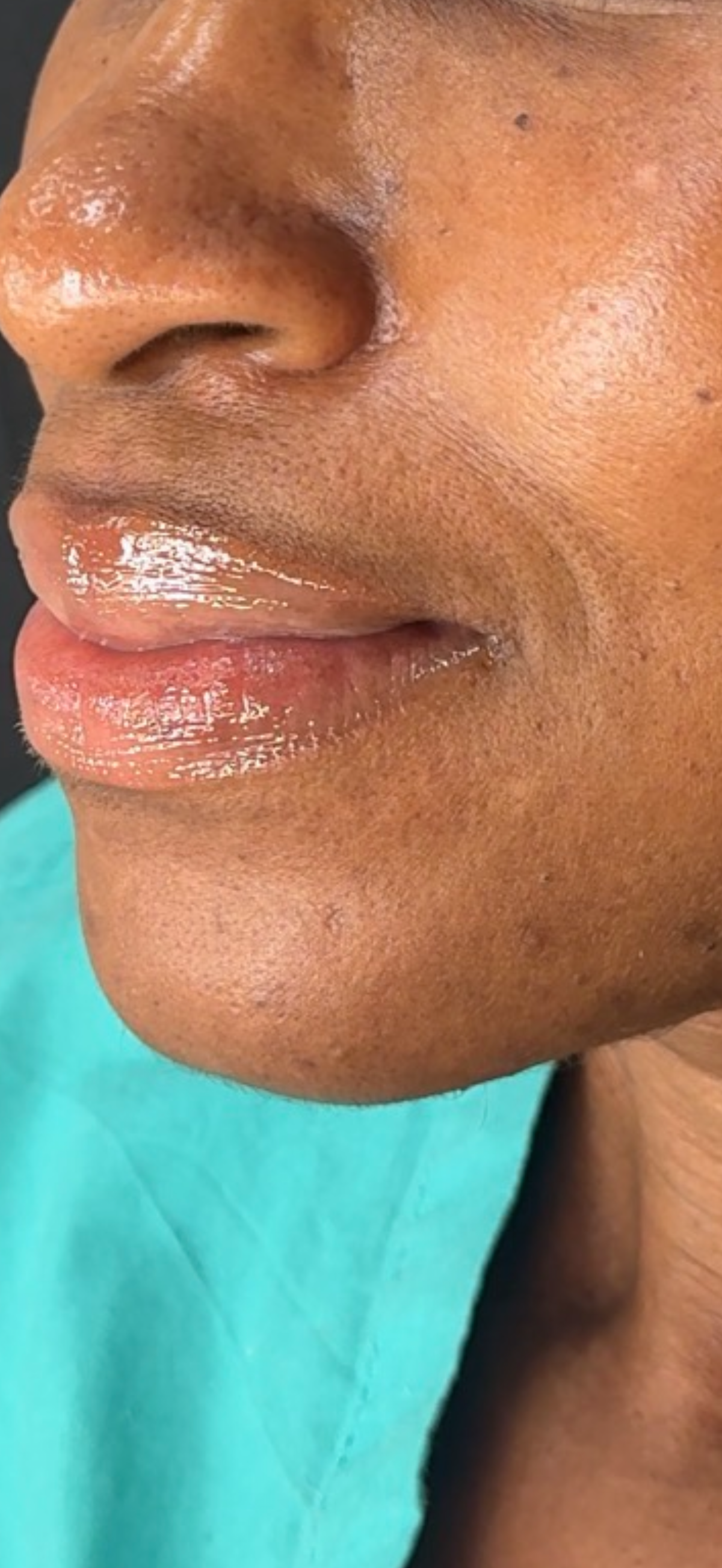 After Combo Treatment - Series of Aerolase Neo + Custom peels