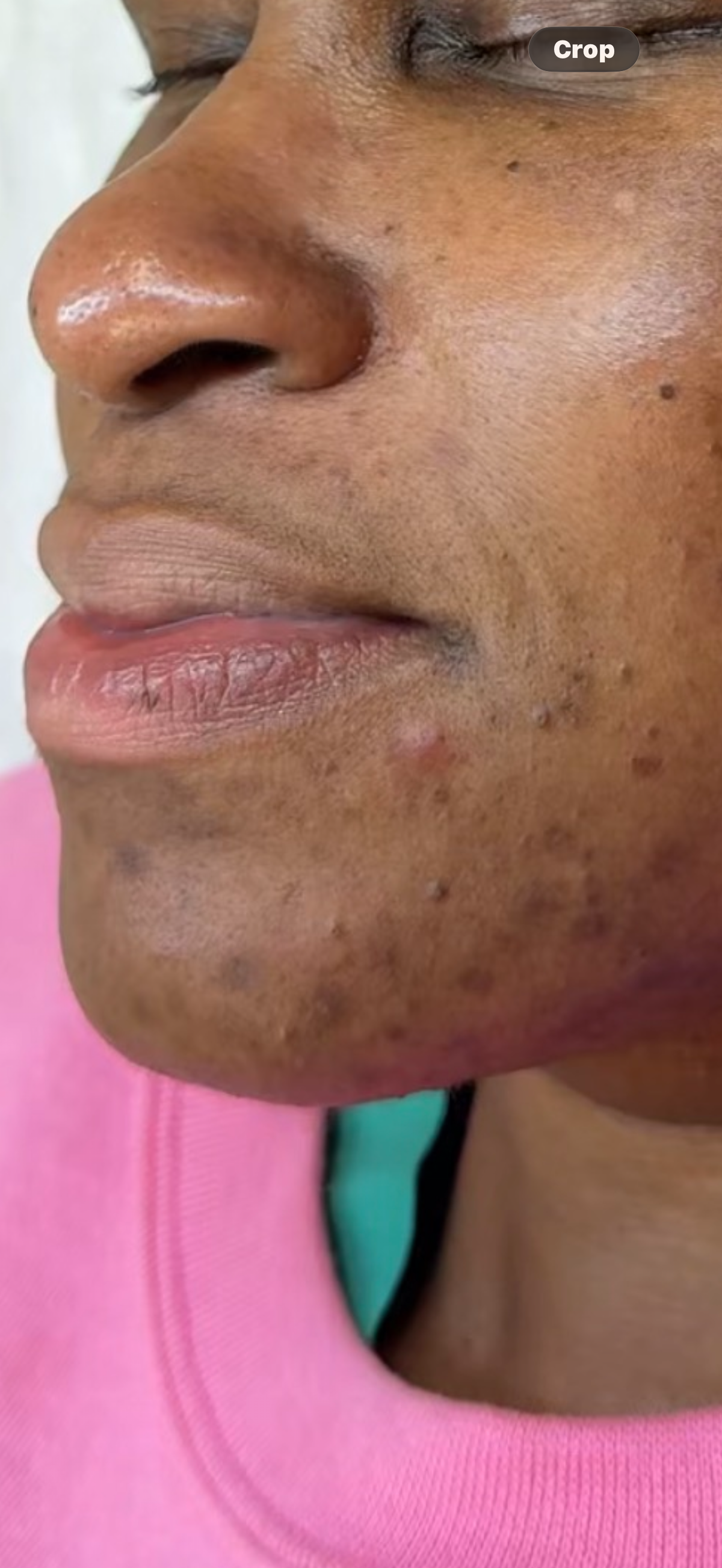 Before Combo Treatment - Series of Aerolase Neo + Custom peels