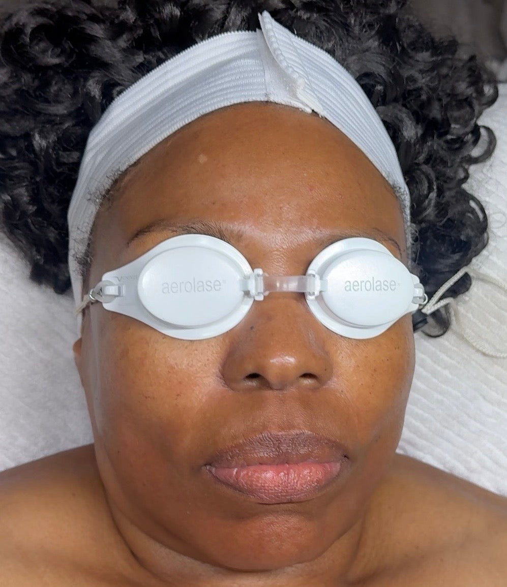 After Combo Treatment - Series of Aerolase Neo + The Glow Facial