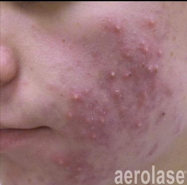 Before Aerolase Laser