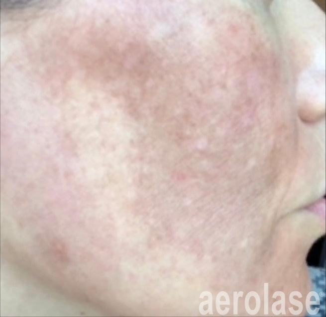 Before Aerolase Laser