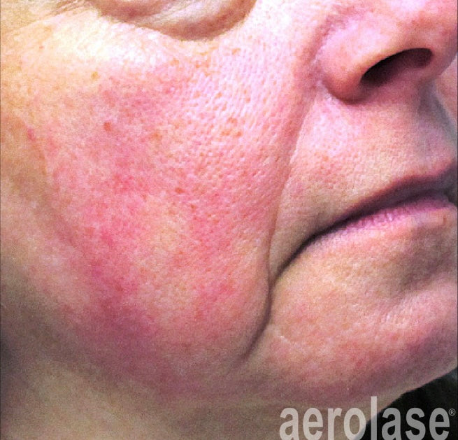 Before Aerolase Laser