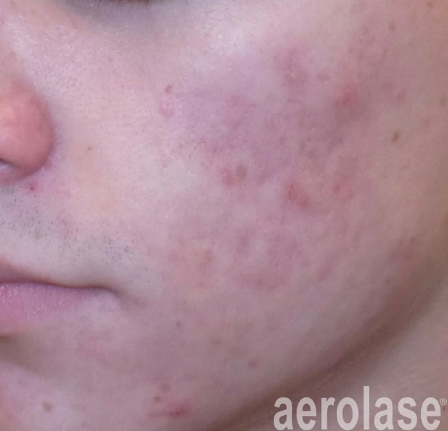 After Aerolase Laser