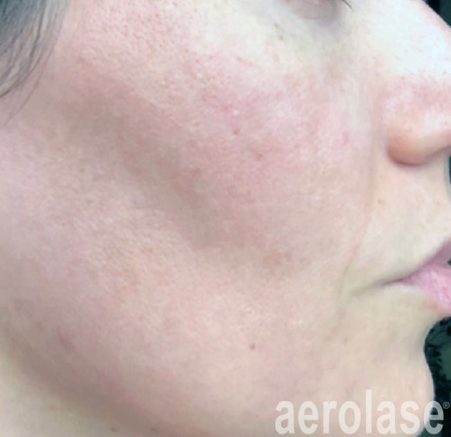 After Aerolase Laser