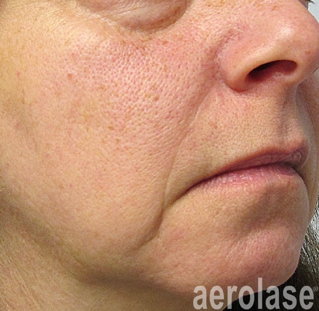 After Aerolase Laser