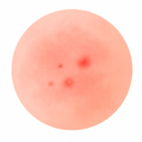 Acne Scarring